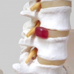 松戸の整体・カイロプラクティックの椎間板ヘルニアで来院された患者様の声、評判